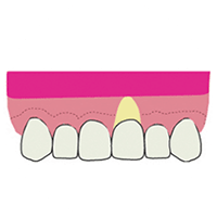 歯周整形治療（痩せた歯ぐきの治療）