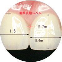 歯の分析